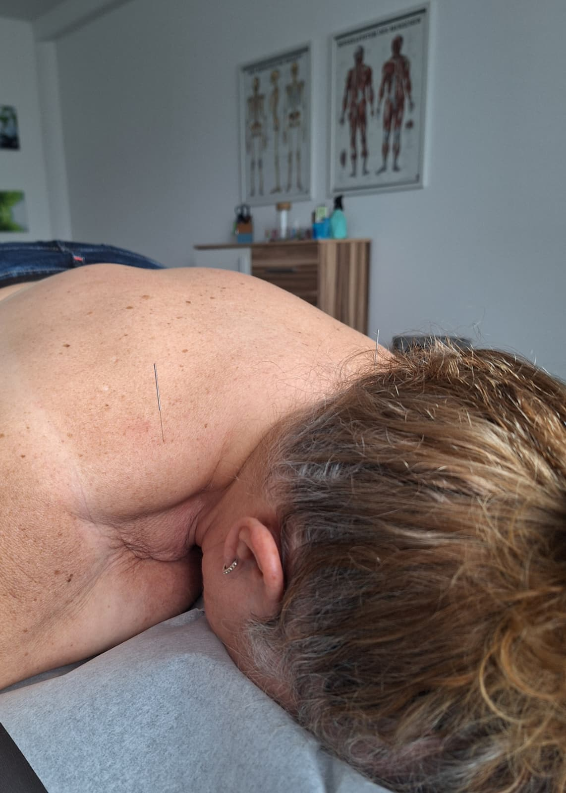 Dry Needling